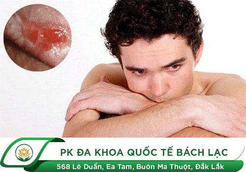 Dương Vật Bị Lở Loét Chữa Ngay Kẻo Ung Thư