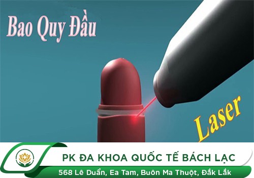 Cắt bao quy đầu bằng laser 