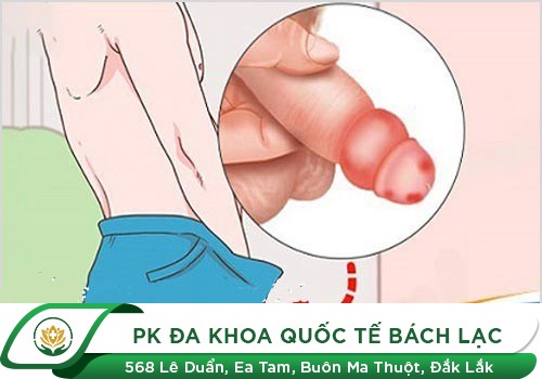 Bao Quy Đầu Bị Đau Là Mắc Phải Bệnh Gì