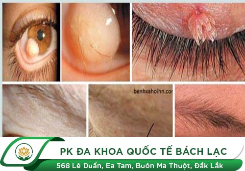 Sùi mào gà ở mắt do đâu?