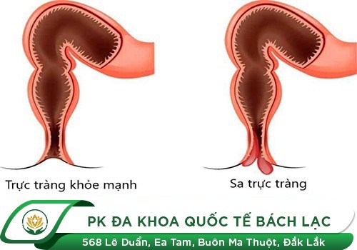Sa Niêm Mạc Trực Tràng – Nguyên Nhân, Triệu Chứng Và Cách Điều Trị Hiệu Quả