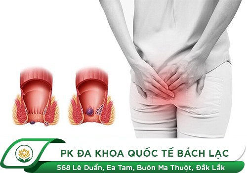 Bệnh trĩ nội là gì?