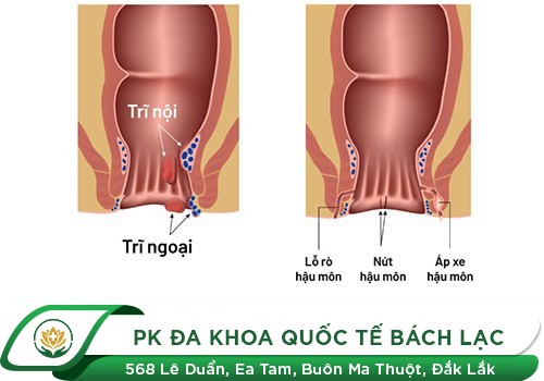 Thuốc bôi chữa các bệnh hậu môn có thực sự hiệu quả?