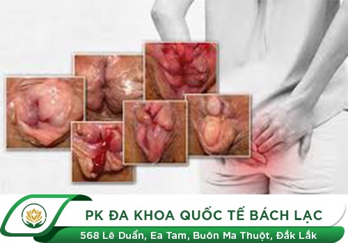 Hậu môn bị lòi thịt dư là dấu hiệu bệnh gì?