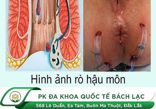 5 Nguy Hiểm Đến Từ Nứt Kẽ Hậu Môn