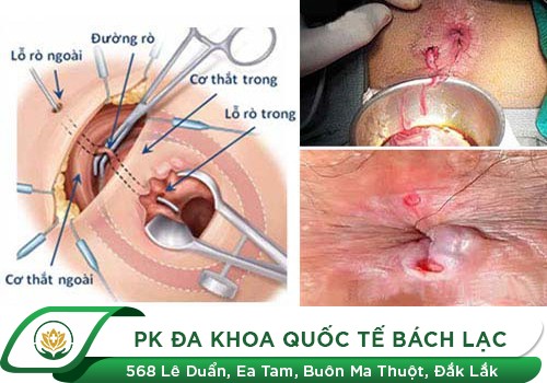 5 tác hại khó lường từ nứt kẽ hậu môn