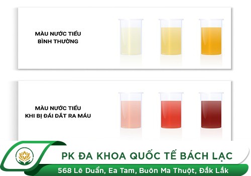 Tiểu Đau Tiểu Ra Máu Là Cảnh Báo Bệnh Gì?