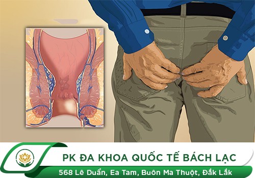 Bị Trĩ Có Ngứa Không