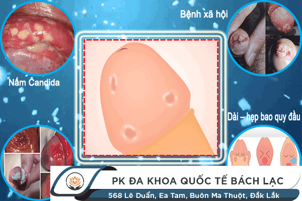 Những Bệnh Nổ Bô Thường Gặp Ở Nam Giới, Cách Trị Như Thế Nào?