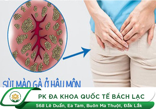 Bệnh Sùi Mào Gà Ở Hậu Môn