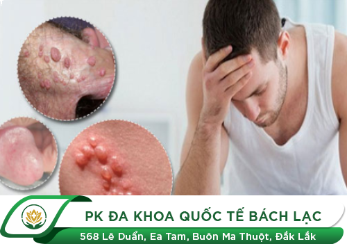 Dương Vật Nổi Cục, Nổi Hạch Là Mắc Bệnh Gì