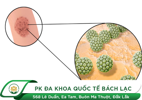 Nổi Mụn Hậu Môn Là Triệu Chứng Của Bệnh Gì