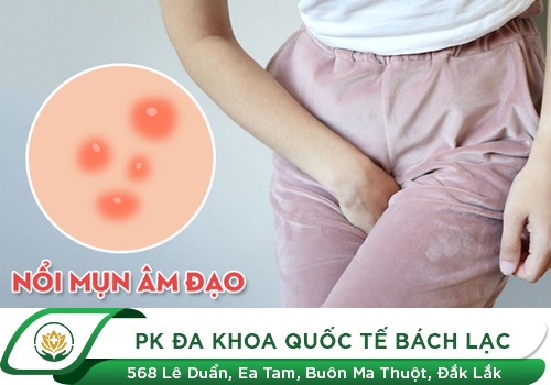 Âm đạo nổi mụn đau rát