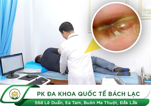 Áp xe hậu môn là gì?
