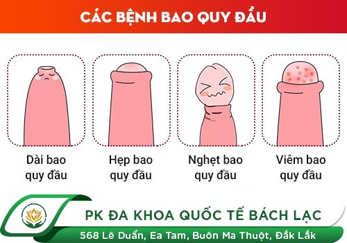 Bệnh Lý Bao Quy Đầu Đừng Xem Thường