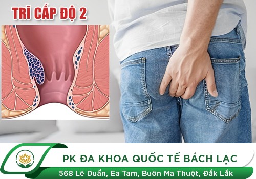 Trĩ cấp độ 2 là như thế nào?