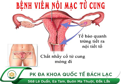 Những Điều Cần Biết Về Bệnh Viêm Nội Mạc Tử Cung Ở Nữ Giới