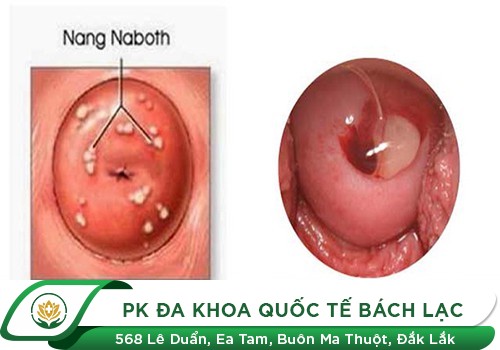 Tất tần tật về bệnh nang naboth cổ tử cung