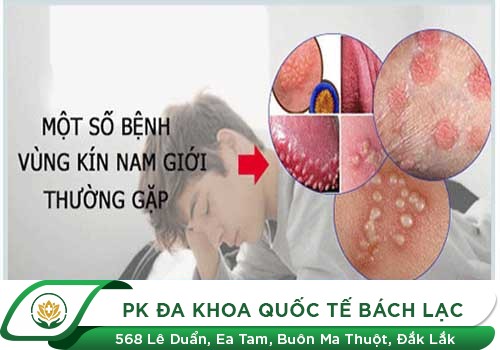 Nổi Hạch Ở Vùng Kín Là Bệnh Gì