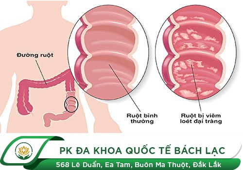 Viêm loét trực tràng