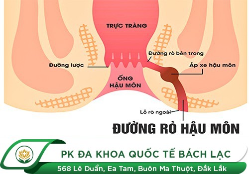 Đi cầu đau rát hậu môn là do đâu