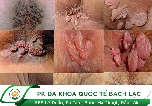 Địa chỉ khám bệnh hậu môn uy tín ở Đắk Lắk