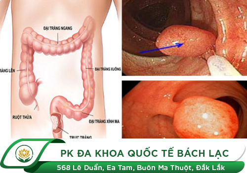 Polyp trực tràng là gì?