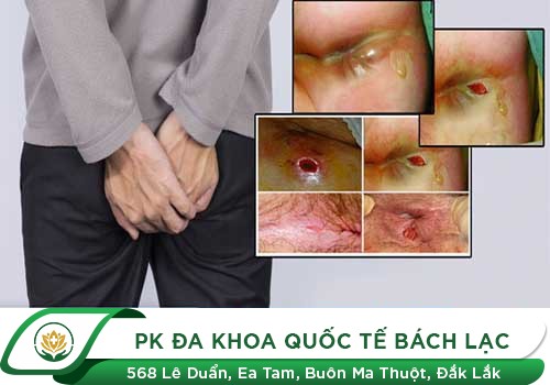 Rách hậu môn là gì?