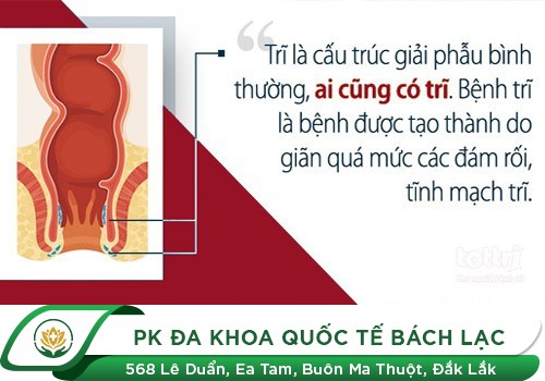 bệnh trĩ