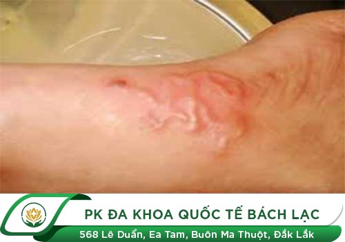 bệnh mạch lươn