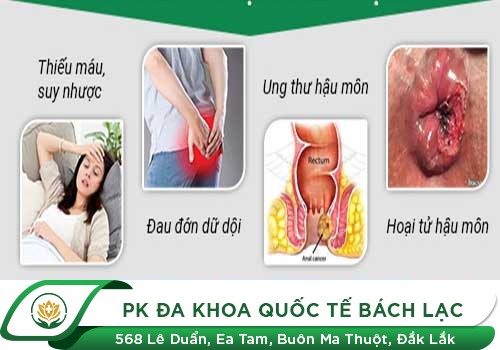 Chữa Rách Hậu Môn Bằng Phương Pháp PPH Hiệu Quả Hiện Nay