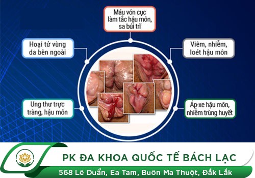 Bệnh trĩ