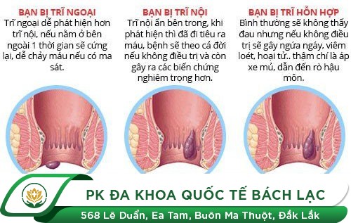 Nhận biết các dạng bệnh trĩ