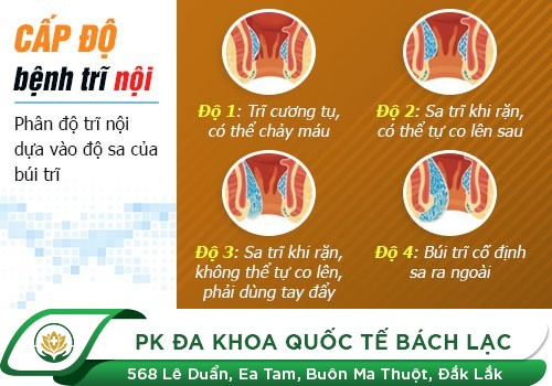 Các Cấp Độ Trĩ Chữa Bằng Cách Nào