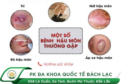 Hiện Tượng Mụn Nhọt Ở Hậu Môn
