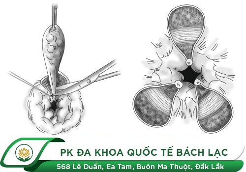 Điều trị bệnh trĩ bằng kỹ thuật thắt búi trĩ truyền thống