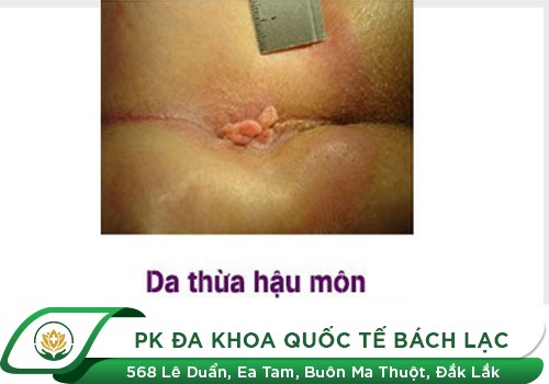 Thịt dư ở hậu môn không đau vì khối da thừa