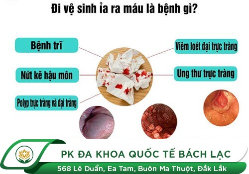 Nguyên nhân gây đi cầu ra máu