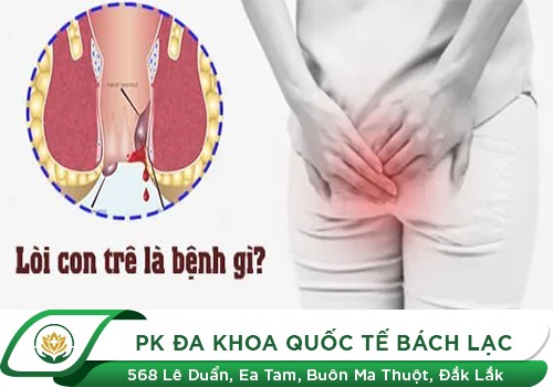 Chữa Nhanh Bệnh Trĩ Con Trê
