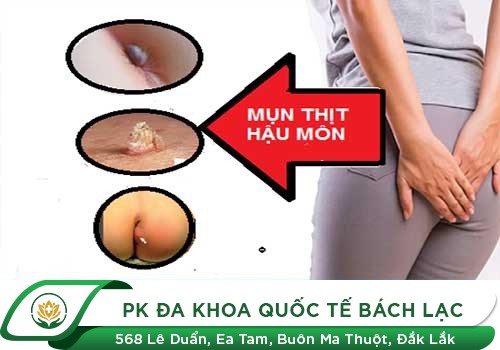 Mụn hậu môn chữa nhanh hiệu quả