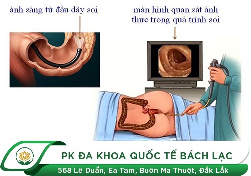 Thực Hiện Nội Soi Trực Tràng Ống Mềm Không Đau