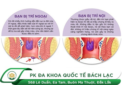 Khác Nhau Giữa Trĩ Nội Và Trĩ Ngoại