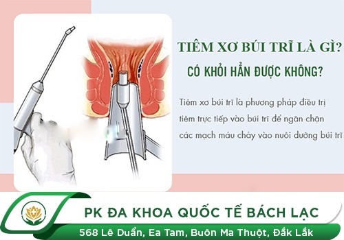  Điều trị bệnh trĩ bằng phương án chích xơ búi trĩ