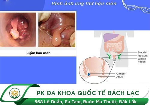  Đi ngoài ra máu tươi nhiều là bị gì?