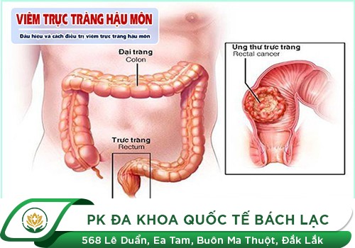 Viêm Trực Tràng Biểu Hiện Thế Nào