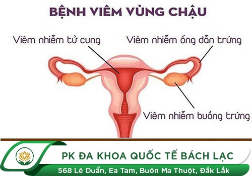 Viêm vùng chậu có nguy hiểm không