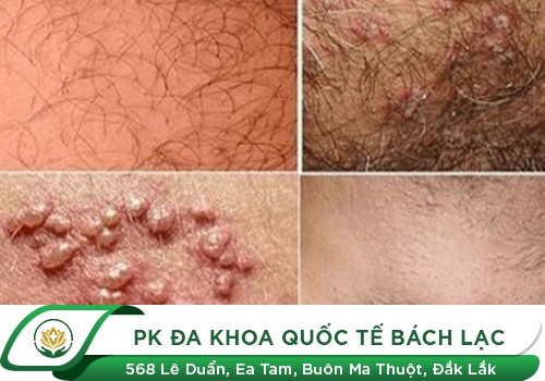 Điểm danh những căn bệnh dễ lây cho cậu nhỏ