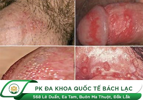 Đi massage có bị lây các bệnh xã hội không