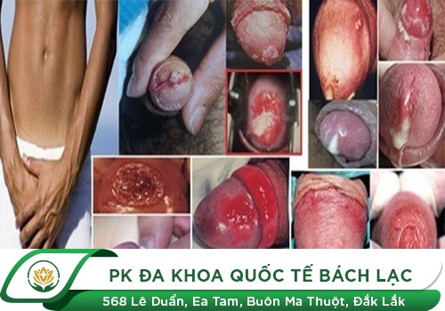 đau dương vật