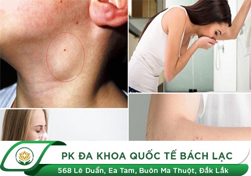 Triệu chứng nhận biết nhiễm HIV